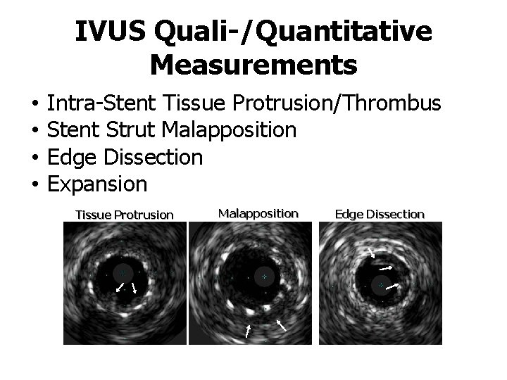 IVUS Quali-/Quantitative Measurements • • Intra-Stent Tissue Protrusion/Thrombus Stent Strut Malapposition Edge Dissection Expansion