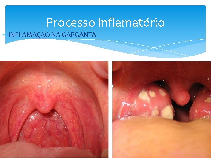 Processo inflamatório INFLAMAÇAO NA GARGANTA 