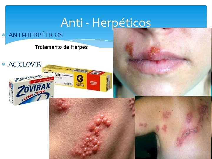 Anti - Herpéticos ANTI-HERPÉTICOS Tratamento da Herpes ACICLOVIR 