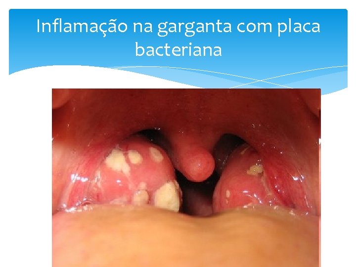 Inflamação na garganta com placa bacteriana 