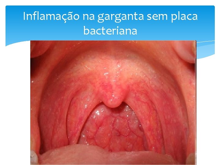 Inflamação na garganta sem placa bacteriana 