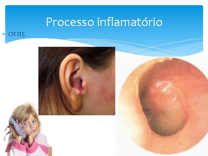  OTITE Processo inflamatório 