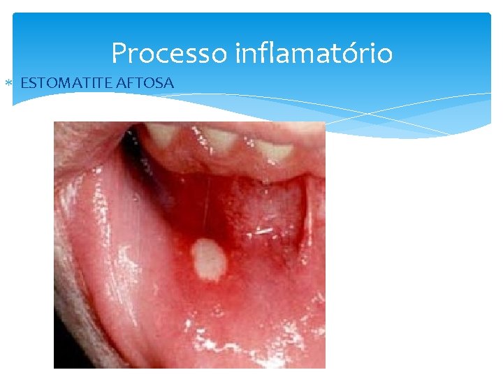 Processo inflamatório ESTOMATITE AFTOSA 