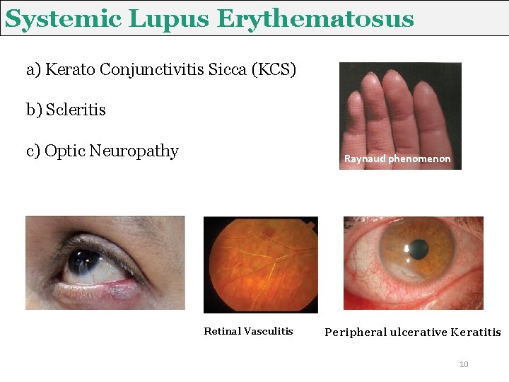 Systemic Lupus Erythematosus a) Kerato Conjunctivitis Sicca (KCS) b) Scleritis c) Optic Neuropathy Raynaud Systemic Lupus Erythematosus a) Kerato Conjunctivitis Sicca (KCS) b) Scleritis c) Optic Neuropathy Raynaud