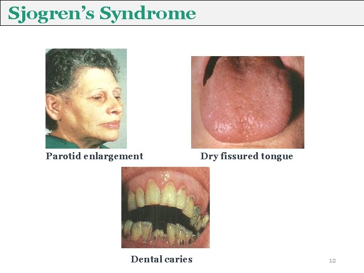 Sjogren’s Syndrome Parotid enlargement Dental caries Dry fissured tongue 12 Sjogren’s Syndrome Parotid enlargement Dental caries Dry fissured tongue 12
