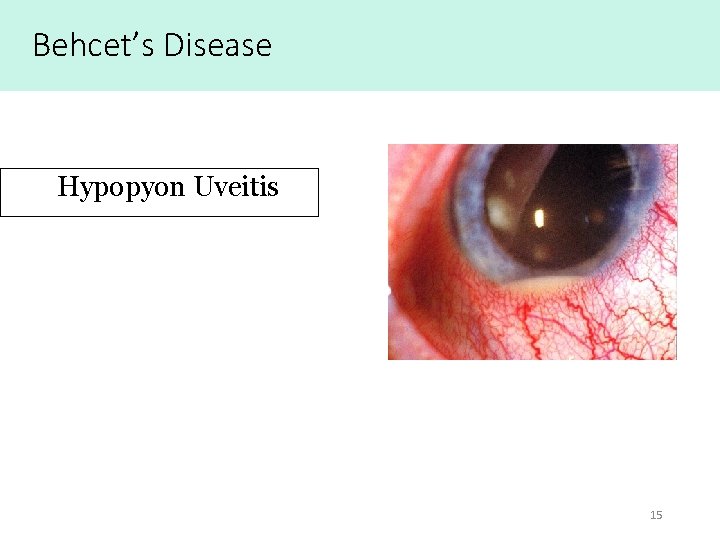 Behcet’s Disease Hypopyon Uveitis 15 Behcet’s Disease Hypopyon Uveitis 15