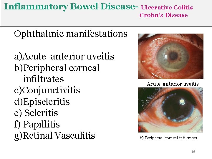 Inflammatory Bowel Disease- Ulcerative Colitis Crohn’s Disease Ophthalmic manifestations a)Acute anterior uveitis b)Peripheral corneal Inflammatory Bowel Disease- Ulcerative Colitis Crohn’s Disease Ophthalmic manifestations a)Acute anterior uveitis b)Peripheral corneal