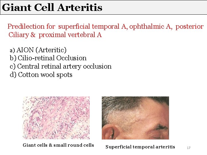 Giant Cell Arteritis Predilection for superficial temporal A, ophthalmic A, posterior Ciliary & proximal Giant Cell Arteritis Predilection for superficial temporal A, ophthalmic A, posterior Ciliary & proximal
