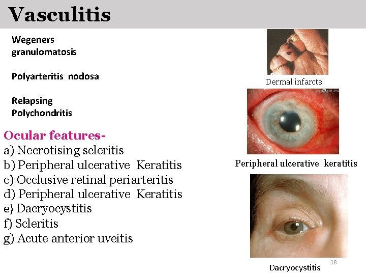 Vasculitis Wegeners granulomatosis Polyarteritis nodosa Dermal infarcts Relapsing Polychondritis Ocular featuresa) Necrotising scleritis b) Vasculitis Wegeners granulomatosis Polyarteritis nodosa Dermal infarcts Relapsing Polychondritis Ocular featuresa) Necrotising scleritis b)