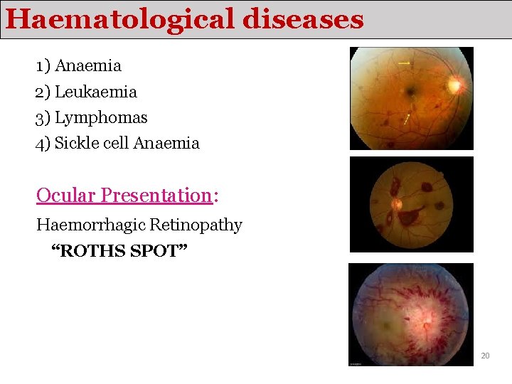 Haematological diseases 1) Anaemia 2) Leukaemia 3) Lymphomas 4) Sickle cell Anaemia Ocular Presentation: Haematological diseases 1) Anaemia 2) Leukaemia 3) Lymphomas 4) Sickle cell Anaemia Ocular Presentation: