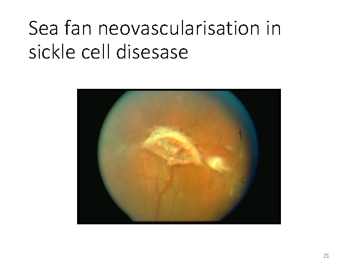 Sea fan neovascularisation in sickle cell disesase 21 Sea fan neovascularisation in sickle cell disesase 21