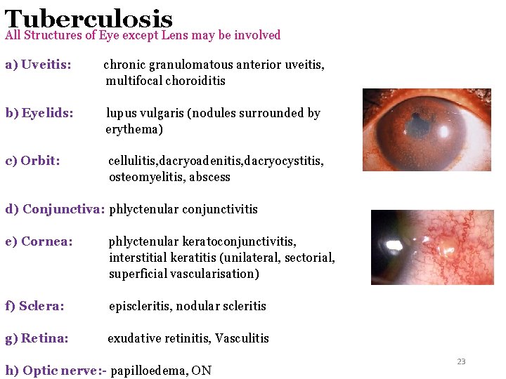 Tuberculosis All Structures of Eye except Lens may be involved a) Uveitis: chronic granulomatous Tuberculosis All Structures of Eye except Lens may be involved a) Uveitis: chronic granulomatous