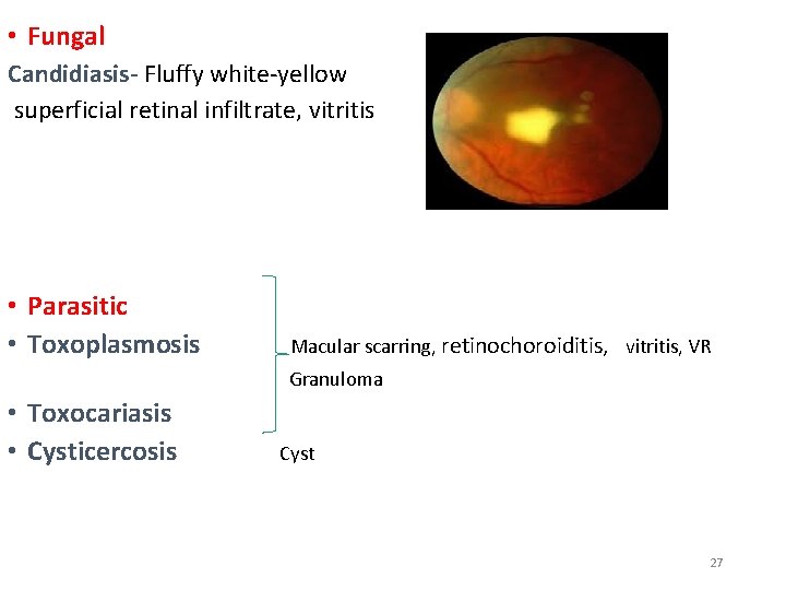 • Fungal Candidiasis- Fluffy white-yellow superficial retinal infiltrate, vitritis • Parasitic • Toxoplasmosis • Fungal Candidiasis- Fluffy white-yellow superficial retinal infiltrate, vitritis • Parasitic • Toxoplasmosis