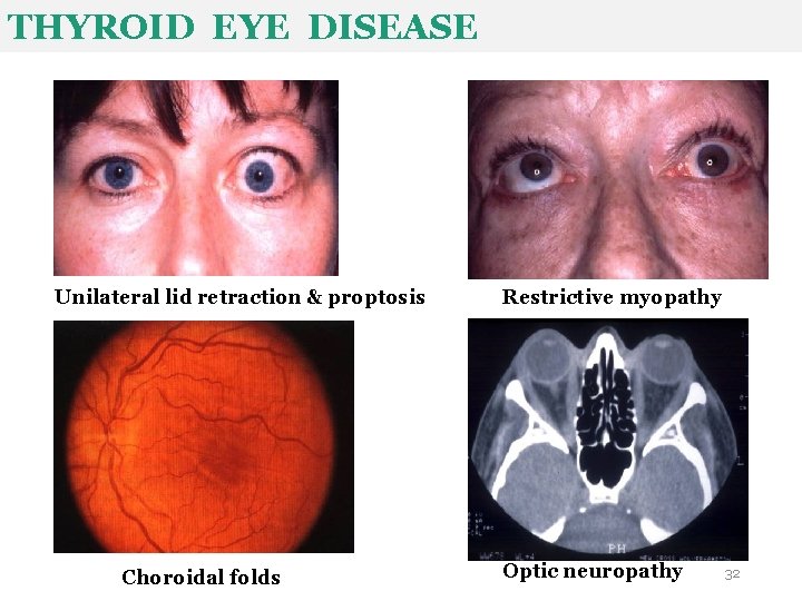 THYROID EYE DISEASE Unilateral lid retraction & proptosis Choroidal folds Restrictive myopathy Optic neuropathy THYROID EYE DISEASE Unilateral lid retraction & proptosis Choroidal folds Restrictive myopathy Optic neuropathy