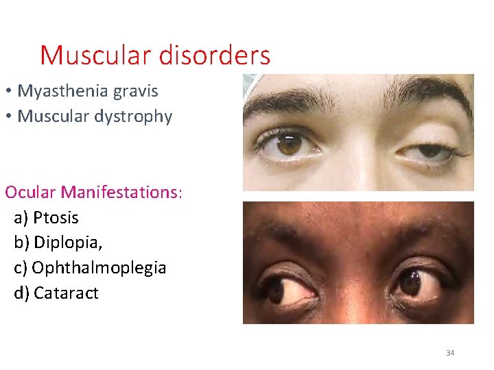 Muscular disorders • Myasthenia gravis • Muscular dystrophy Ocular Manifestations: a) Ptosis b) Diplopia, Muscular disorders • Myasthenia gravis • Muscular dystrophy Ocular Manifestations: a) Ptosis b) Diplopia,