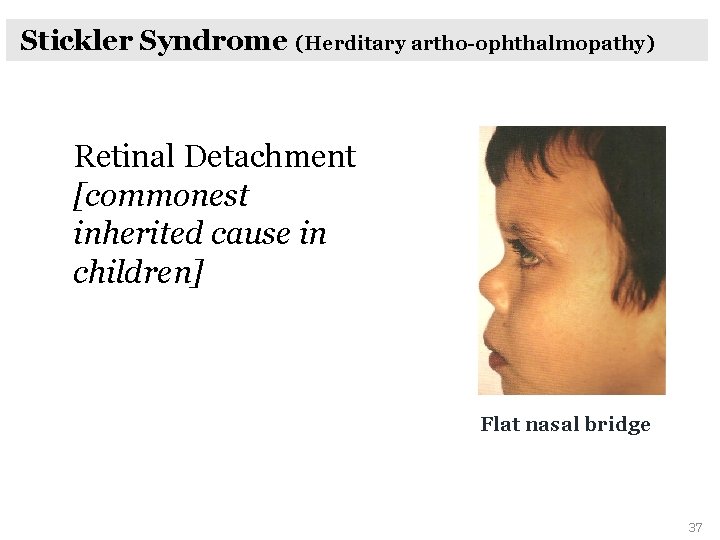 Stickler Syndrome (Herditary artho-ophthalmopathy) Retinal Detachment [commonest inherited cause in children] Flat nasal bridge