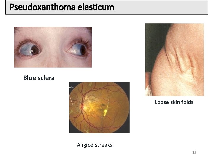 Pseudoxanthoma elasticum Blue sclera Loose skin folds Angiod streaks 38 Pseudoxanthoma elasticum Blue sclera Loose skin folds Angiod streaks 38