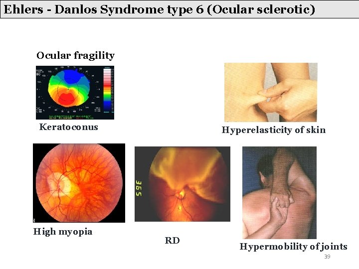 Ehlers - Danlos Syndrome type 6 (Ocular sclerotic) Ocular fragility Keratoconus High myopia Hyperelasticity Ehlers - Danlos Syndrome type 6 (Ocular sclerotic) Ocular fragility Keratoconus High myopia Hyperelasticity