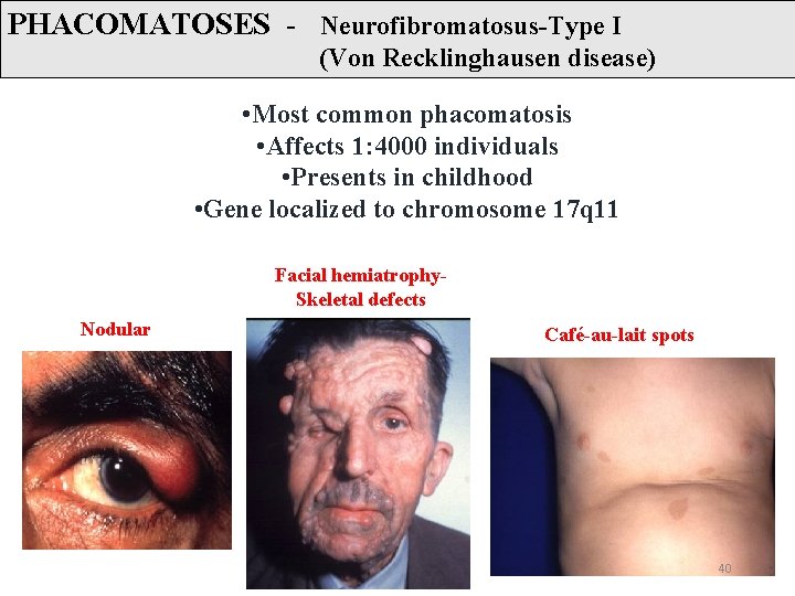 PHACOMATOSES - Neurofibromatosus-Type I (Von Recklinghausen disease) • Most common phacomatosis • Affects 1: PHACOMATOSES - Neurofibromatosus-Type I (Von Recklinghausen disease) • Most common phacomatosis • Affects 1: