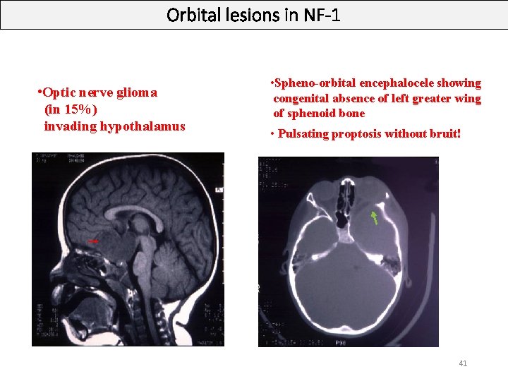 Orbital lesions in NF-1 • Optic nerve glioma (in 15%) invading hypothalamus • Spheno-orbital Orbital lesions in NF-1 • Optic nerve glioma (in 15%) invading hypothalamus • Spheno-orbital