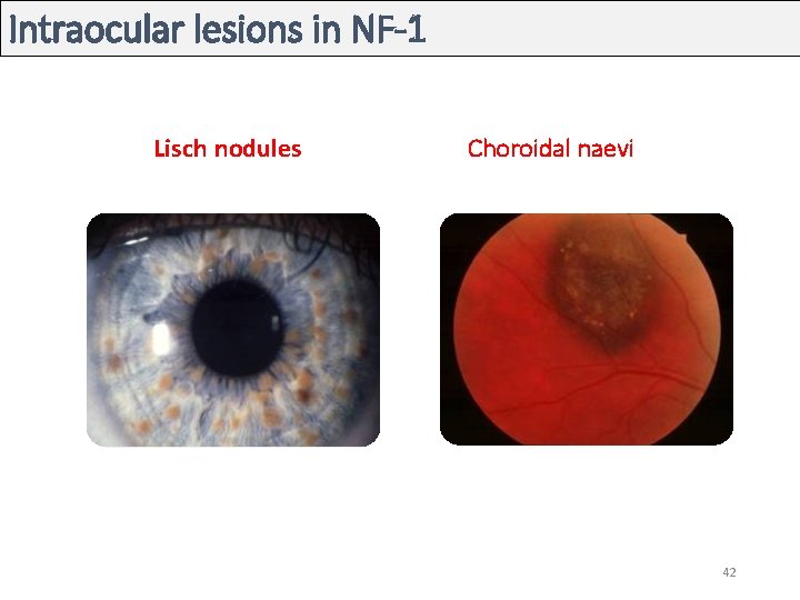 Intraocular lesions in NF-1 Lisch nodules Choroidal naevi 42 Intraocular lesions in NF-1 Lisch nodules Choroidal naevi 42