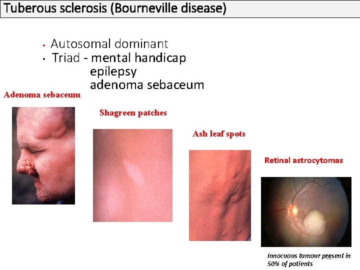Tuberous sclerosis (Bourneville disease) Autosomal dominant • Triad - mental handicap epilepsy adenoma sebaceum Tuberous sclerosis (Bourneville disease) Autosomal dominant • Triad - mental handicap epilepsy adenoma sebaceum