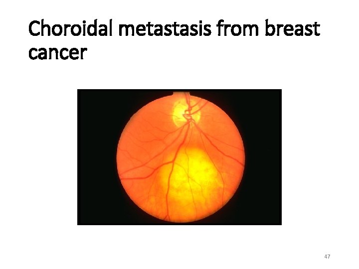 Choroidal metastasis from breast cancer 47 Choroidal metastasis from breast cancer 47