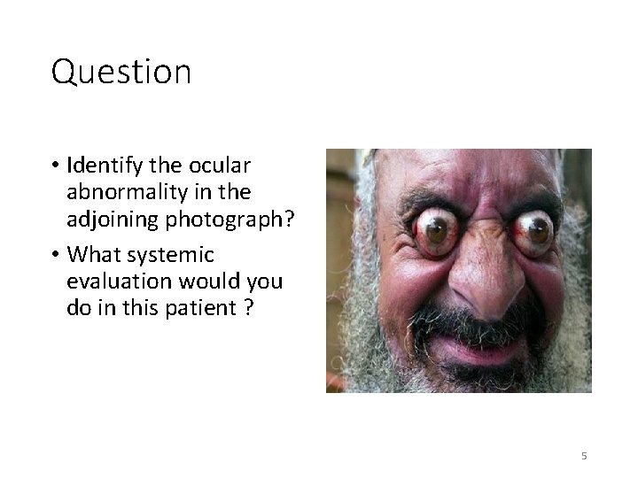 Question • Identify the ocular abnormality in the adjoining photograph? • What systemic evaluation Question • Identify the ocular abnormality in the adjoining photograph? • What systemic evaluation