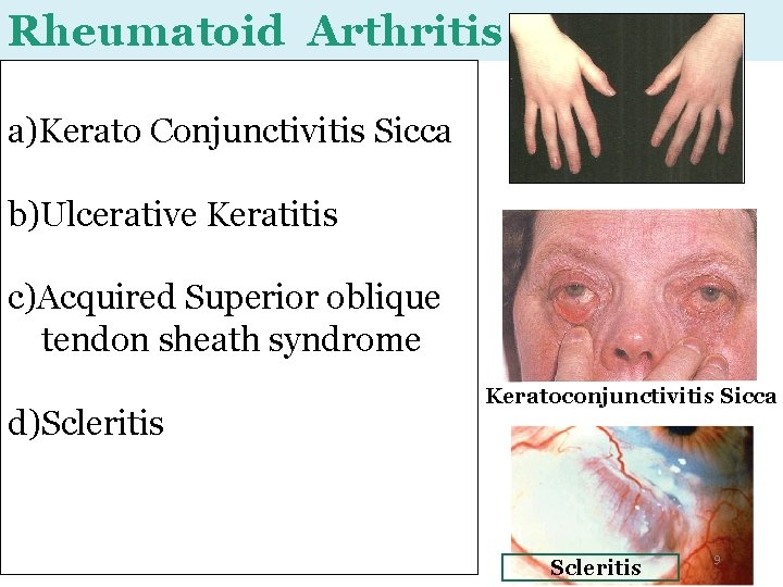 Rheumatoid Arthritis a)Kerato Conjunctivitis Sicca b)Ulcerative Keratitis c)Acquired Superior oblique tendon sheath syndrome d)Scleritis Rheumatoid Arthritis a)Kerato Conjunctivitis Sicca b)Ulcerative Keratitis c)Acquired Superior oblique tendon sheath syndrome d)Scleritis