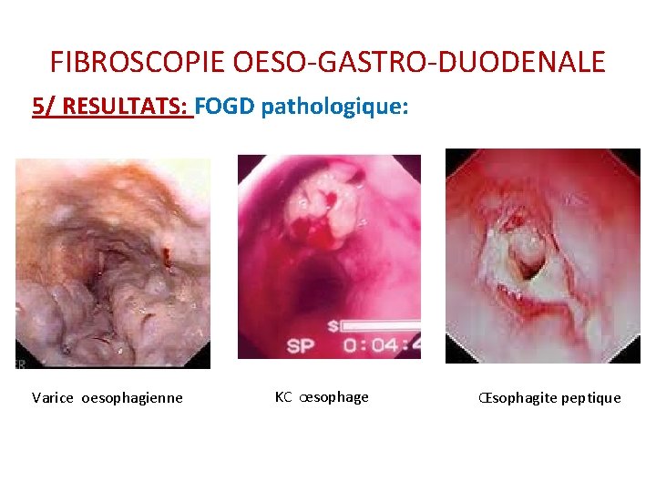 FIBROSCOPIE OESO-GASTRO-DUODENALE 5/ RESULTATS: FOGD pathologique: Varice oesophagienne KC œsophage Œsophagite peptique FIBROSCOPIE OESO-GASTRO-DUODENALE 5/ RESULTATS: FOGD pathologique: Varice oesophagienne KC œsophage Œsophagite peptique