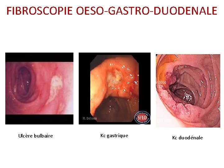 FIBROSCOPIE OESO-GASTRO-DUODENALE Ulcère bulbaire Kc gastrique Kc duodénale FIBROSCOPIE OESO-GASTRO-DUODENALE Ulcère bulbaire Kc gastrique Kc duodénale