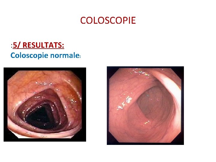 COLOSCOPIE : 5/ RESULTATS: Coloscopie normale: COLOSCOPIE : 5/ RESULTATS: Coloscopie normale: