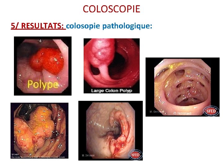 COLOSCOPIE 5/ RESULTATS: colosopie pathologique: COLOSCOPIE 5/ RESULTATS: colosopie pathologique: