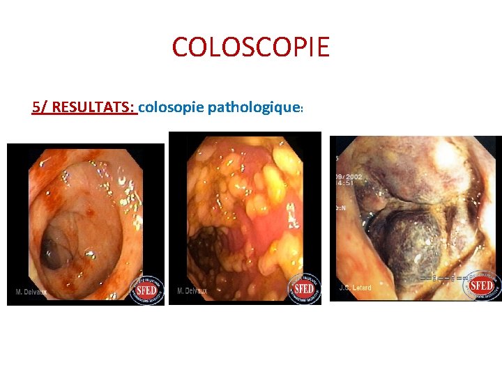 COLOSCOPIE 5/ RESULTATS: colosopie pathologique: COLOSCOPIE 5/ RESULTATS: colosopie pathologique: