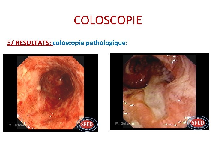 COLOSCOPIE 5/ RESULTATS: coloscopie pathologique: COLOSCOPIE 5/ RESULTATS: coloscopie pathologique:
