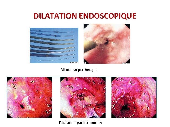 DILATATION ENDOSCOPIQUE Dilatation par bougies Dilatation par ballonnets DILATATION ENDOSCOPIQUE Dilatation par bougies Dilatation par ballonnets