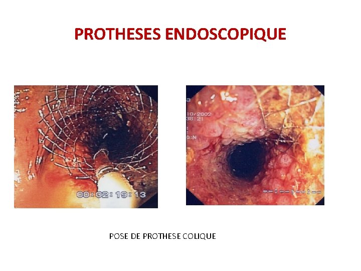 PROTHESES ENDOSCOPIQUE POSE DE PROTHESE COLIQUE PROTHESES ENDOSCOPIQUE POSE DE PROTHESE COLIQUE
