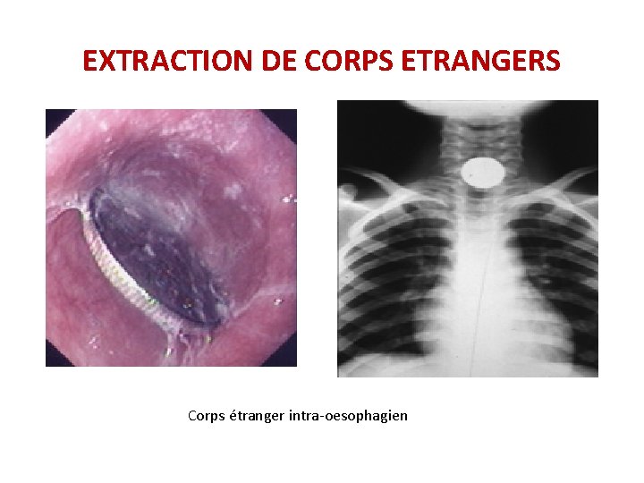 EXTRACTION DE CORPS ETRANGERS Corps étranger intra-oesophagien EXTRACTION DE CORPS ETRANGERS Corps étranger intra-oesophagien