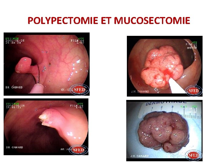 POLYPECTOMIE ET MUCOSECTOMIE POLYPECTOMIE ET MUCOSECTOMIE