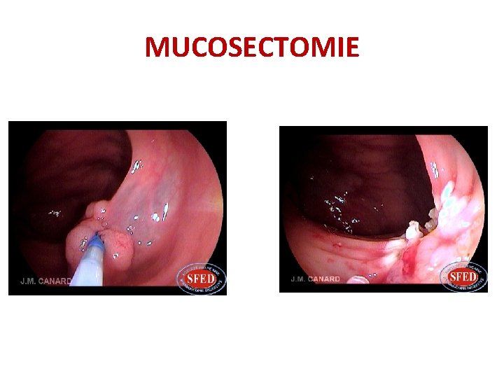 MUCOSECTOMIE MUCOSECTOMIE