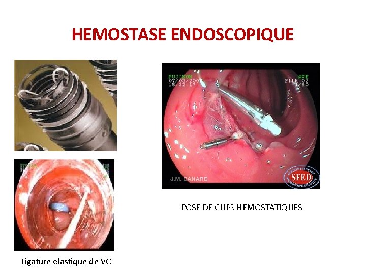 HEMOSTASE ENDOSCOPIQUE POSE DE CLIPS HEMOSTATIQUES Ligature elastique de VO HEMOSTASE ENDOSCOPIQUE POSE DE CLIPS HEMOSTATIQUES Ligature elastique de VO