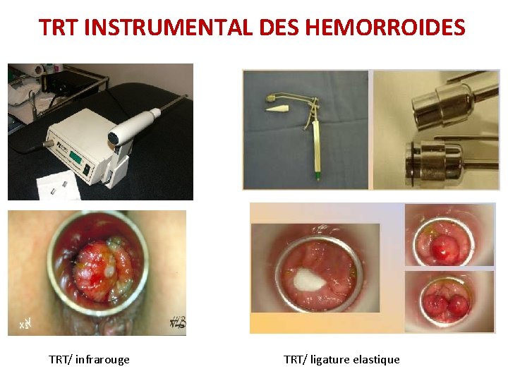 TRT INSTRUMENTAL DES HEMORROIDES TRT/ infrarouge TRT/ ligature elastique TRT INSTRUMENTAL DES HEMORROIDES TRT/ infrarouge TRT/ ligature elastique