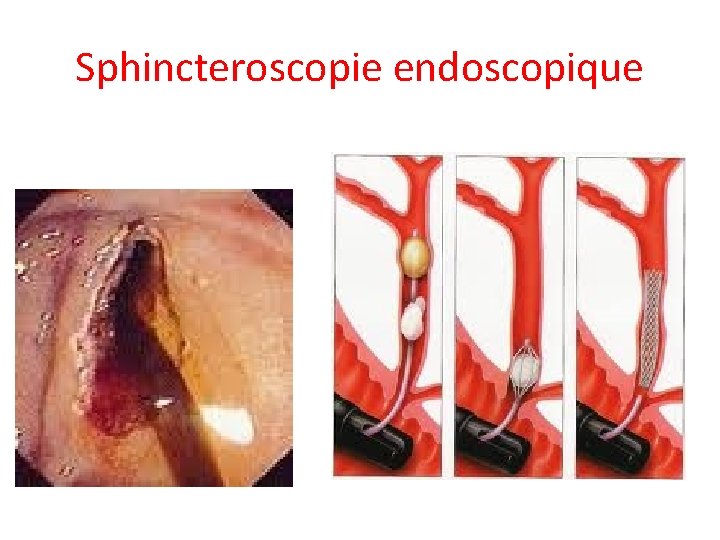 Sphincteroscopie endoscopique Sphincteroscopie endoscopique