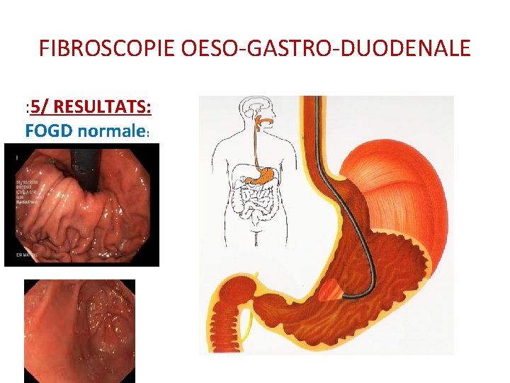 FIBROSCOPIE OESO-GASTRO-DUODENALE : 5/ RESULTATS: FOGD normale: FIBROSCOPIE OESO-GASTRO-DUODENALE : 5/ RESULTATS: FOGD normale: