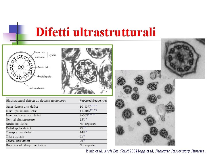 Difetti ultrastrutturali Bush et al, Arch Dis Child 2007; Hogg et al, Pediatric Respiratory