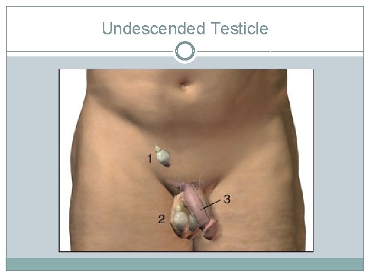 Undescended Testicle 