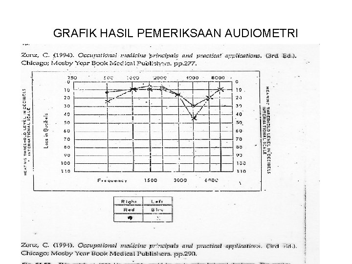 GRAFIK HASIL PEMERIKSAAN AUDIOMETRI 