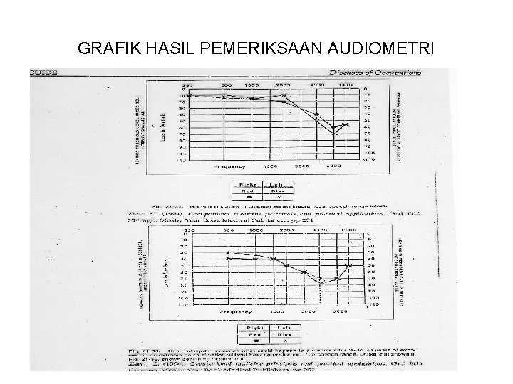 GRAFIK HASIL PEMERIKSAAN AUDIOMETRI 