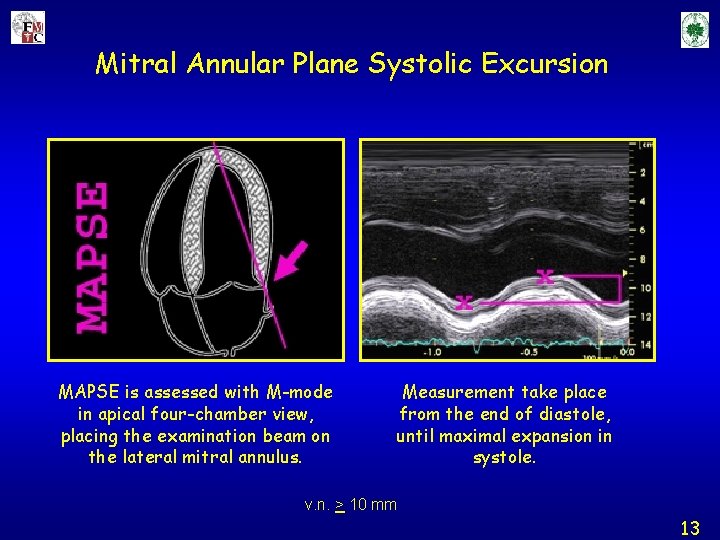 Mitral Annular Plane Systolic Excursion MAPSE is assessed with M-mode in apical four-chamber view,