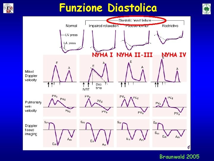 Funzione Diastolica NYHA II-III NYHA IV Braunwald 2005 